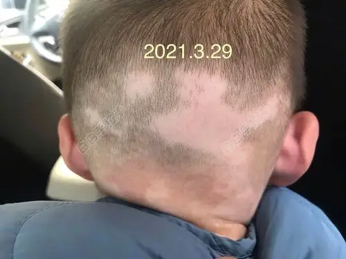 宝宝半岁发现头上有点白,如今已全身发展,求帮助!