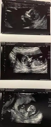 英国双子宫妈妈罕见怀上三胞胎两边的孩子在轮流踢我