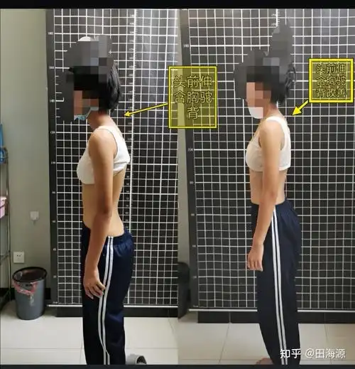 15岁脊柱侧弯16度(线下1个月)