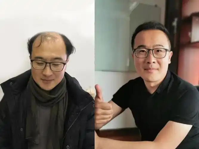 紧急通知全城寻找脱发秃顶发际线高头部疤痕等人群免费援助