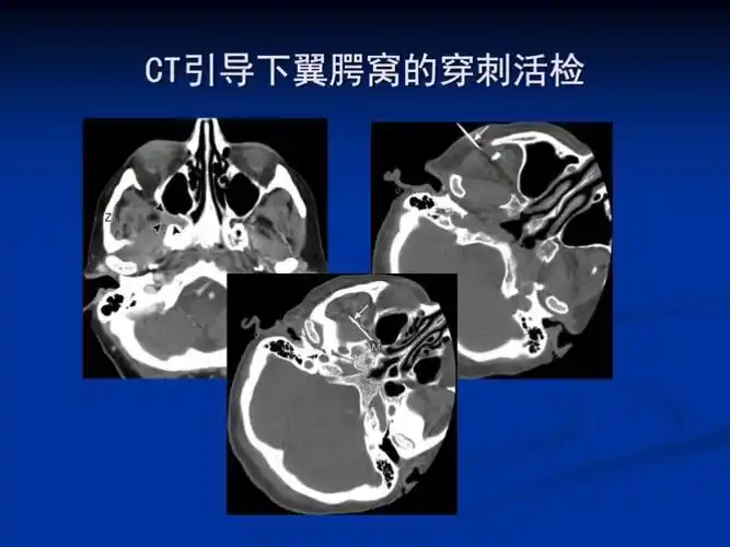 翼腭窝(ppf)解剖及影像学评价