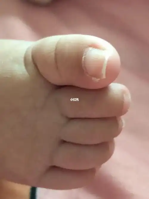 宝宝的脚指甲这样是怎么回事