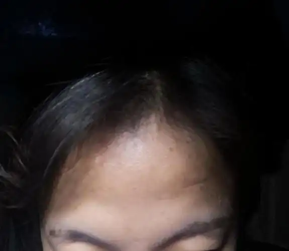 有没有姐妹额头是这样的