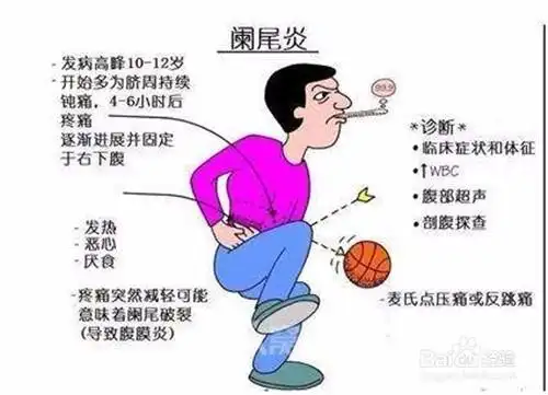 阑尾炎是什么样的 急性阑尾炎早期有什么症状