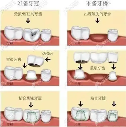 门牙缺失种牙好还是镶牙好这有种植牙和镶牙的区别图解