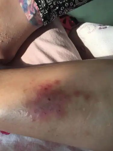 被蚊子咬完.挠了挠.就这样了. 这怎么弄