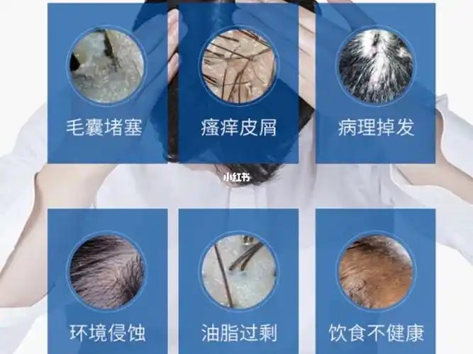 干货|头屑 头痒的原因_头屑_去屑_止痒_医疗健康_医疗健康其他