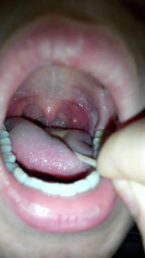 有什么危害 要不要去医院 很急 希望了