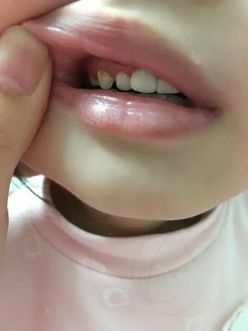 宝宝4岁 牙齿缺了个洞 这是钙化还是蛀牙呢?着急啊