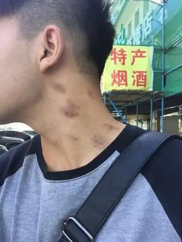 吻痕是怎么弄出来的 吻痕是怎么弄出来的图 -育儿知识