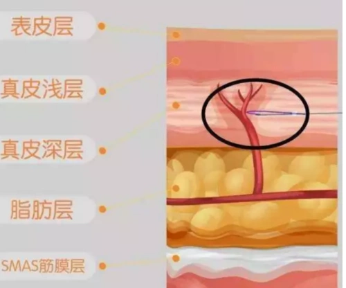 蛋白线进入体内会破怀皮表层,依次是真皮层,皮下组织,筋膜层,如果在