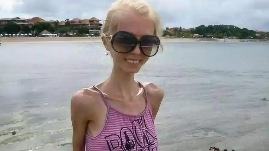 世界上最瘦的女人,俄罗斯女孩仅20公斤