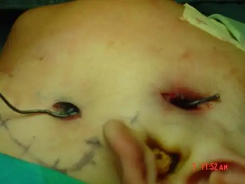 鳃裂囊肿和瘘管