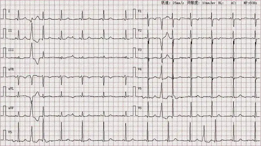 心电图图库室性早搏系列