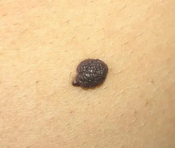 腰部以上的大黑痣