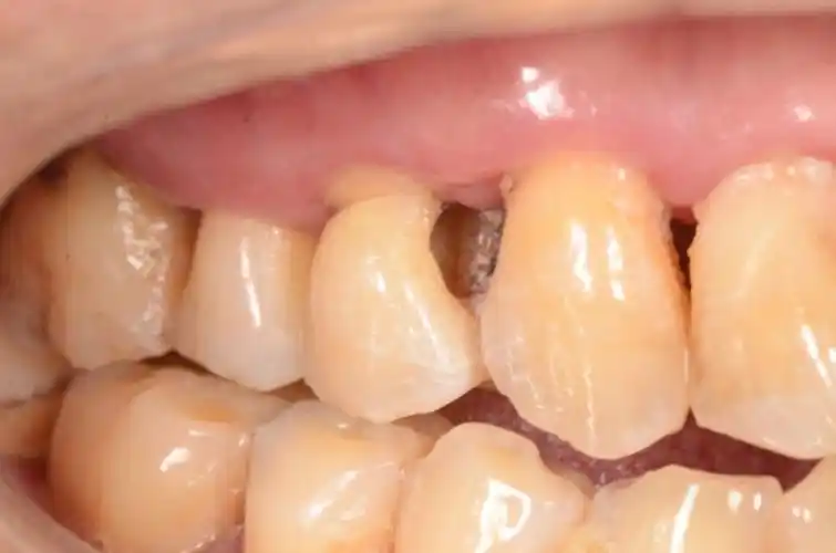 【树脂直接修复病例】 1 4#邻面洞95 15 颈部楔缺  颌面洞95