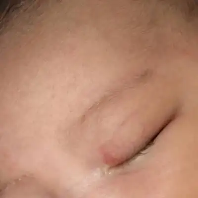 宝宝出生眼皮就红一块 一个半月了 也没掉 有人知道这是什麼吗