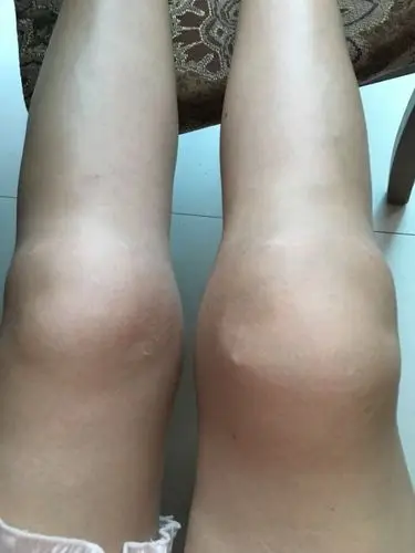 膝盖疼痛肿怎么拍打?