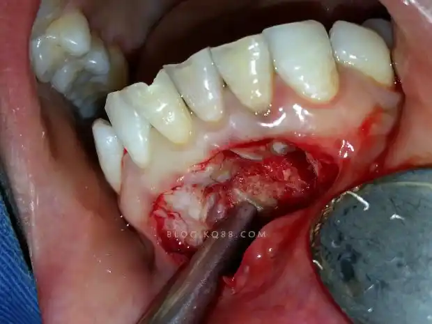 一例根尖区手术病例