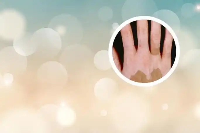 嘴角白斑初期症状图片-中华皮肤病网