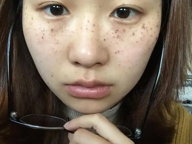 天生雀斑"难自弃",做个激光祛斑解决下"面子"问题!