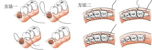 牙周治疗手术缝合线缝合方法示意图.jpg