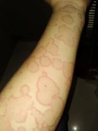 求助,这是荨麻疹性血管炎吗?