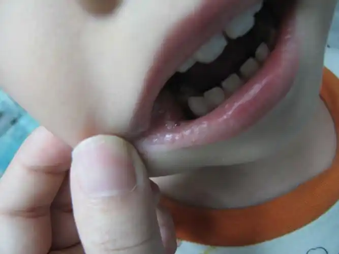 皮肤病口腔念珠菌感染