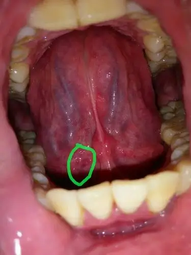 舌头底下有5-6粒肉疙瘩(约半截米粒大小)不痛不痒