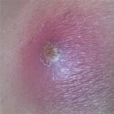 屁股上长疙瘩是什么原因