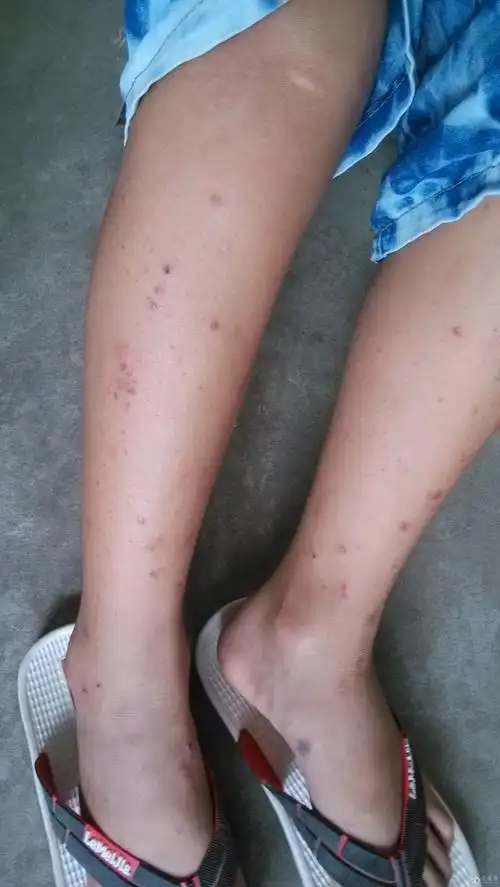 疑似过敏性紫癜一例