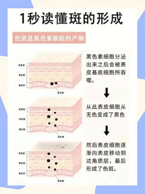 先了解斑如何形成才能对症处理才不走弯路