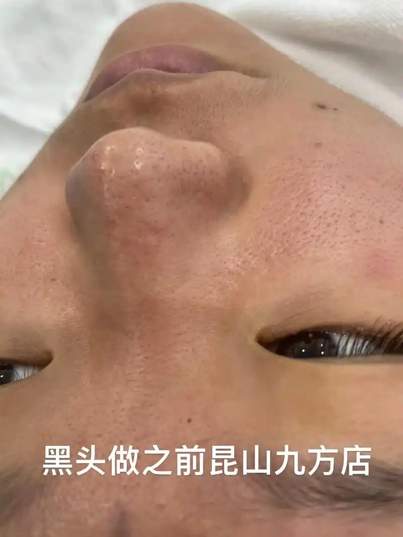 深层毛孔清洁做黑头前后的对比图,大家快来找我们给皮肤深层次 - 抖