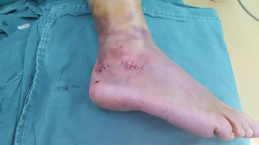 跟骨骨折治疗的安全选择 - 好大夫在线