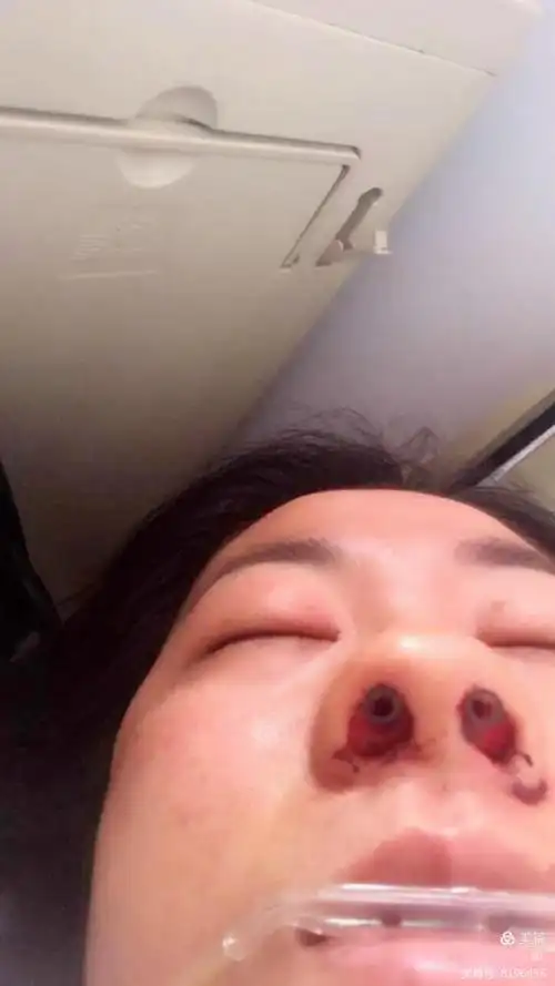 鼻腔手术怎一个痛字了得!还有钻脑钻心的酸!