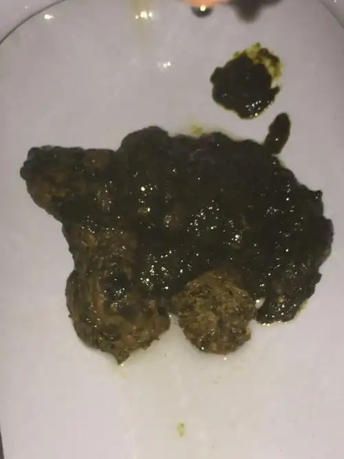 大便异常,有慢性肠胃炎这个便是消化道流血了吗 答题抽奖 首次日骀