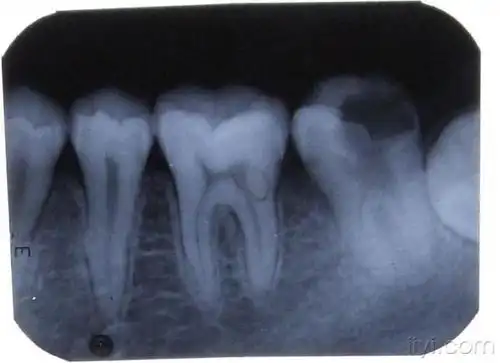 〈附牙片〉 - 口腔医学专业讨论版 - 爱爱医医学论坛 - 爱爱医医学网
