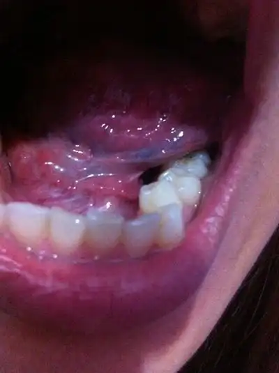 口腔癌图片_口腔癌症状表现图片大全_有来医生