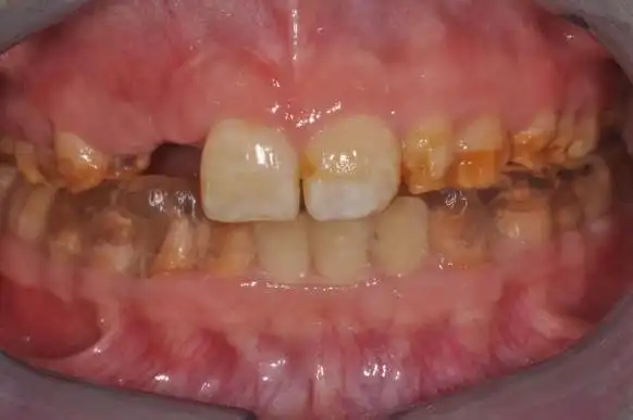 釉质发育不全的咬合重建一例2019escd认证病例