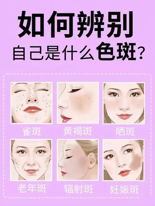 如何辨别自己的斑点类型建议收藏
