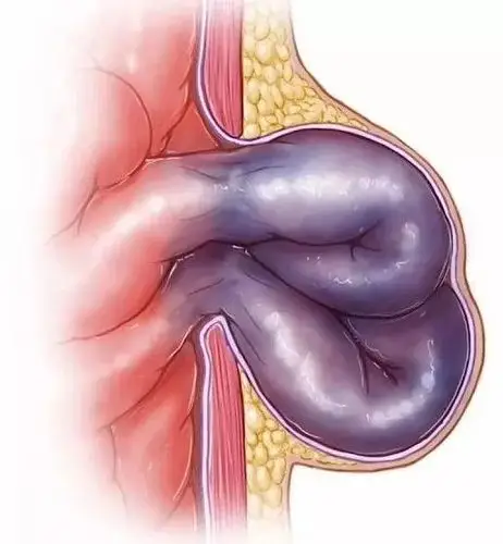 义诊预告疝始善终普外科将举办疝病公益义诊活动
