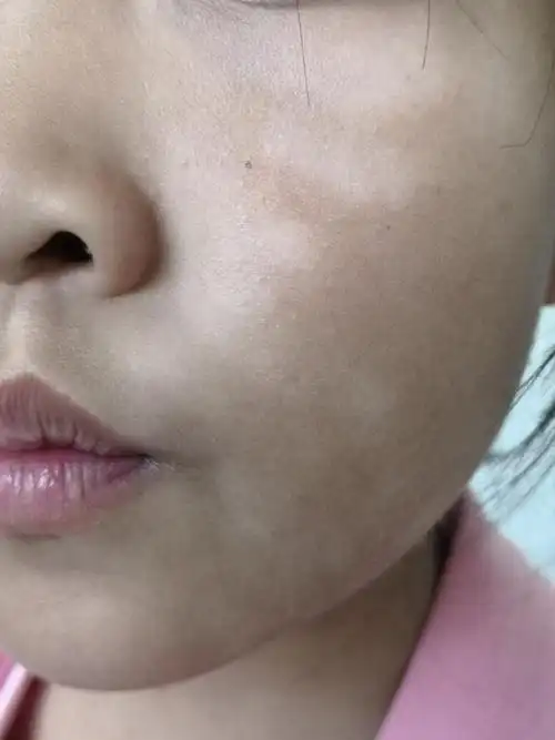 白色糠疹##解决皮肤问题专注皮肤美容