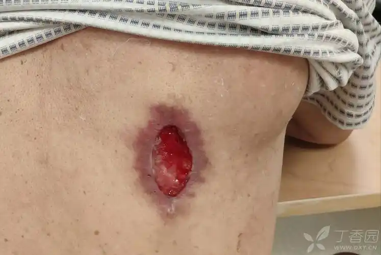 皮脂腺囊肿这么切,是砸自己的招牌