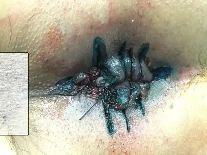 手术方式:环状混合痔分段外切内扎术,肛门内括约肌侧切术,肛乳头瘤