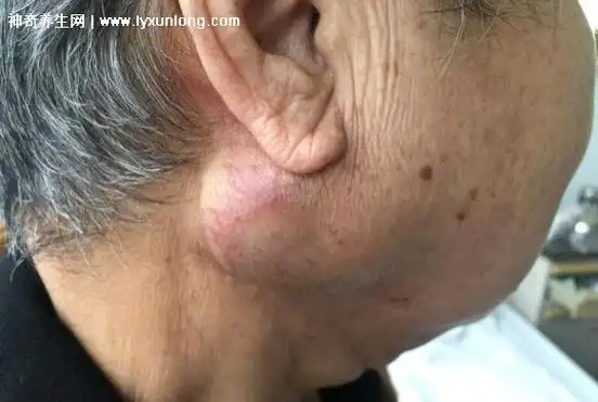 耳后淋巴结肿大图片位置及病因,淋巴结炎肿大发红(警惕鼻咽癌)