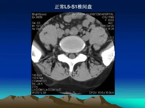 腰椎ct诊断ppt