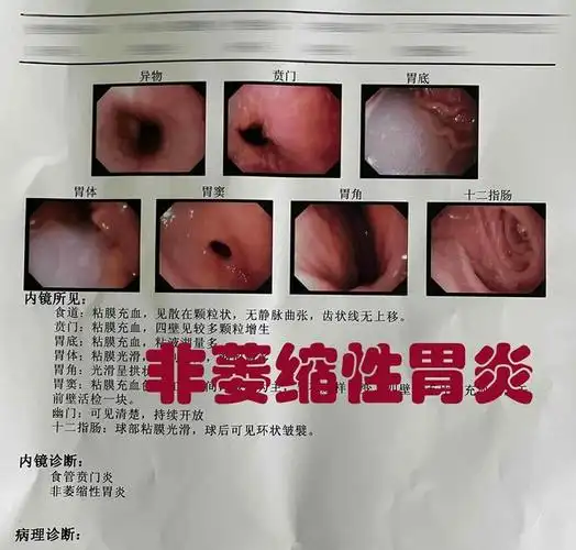 慢性非萎缩性胃炎,要不要吃什么药物治疗?