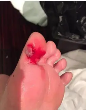 陈乔恩晒淤血照 粉丝直呼心疼