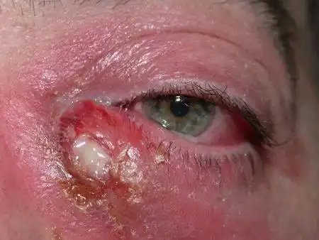 通了泪囊炎母亲可以吃辣吗?