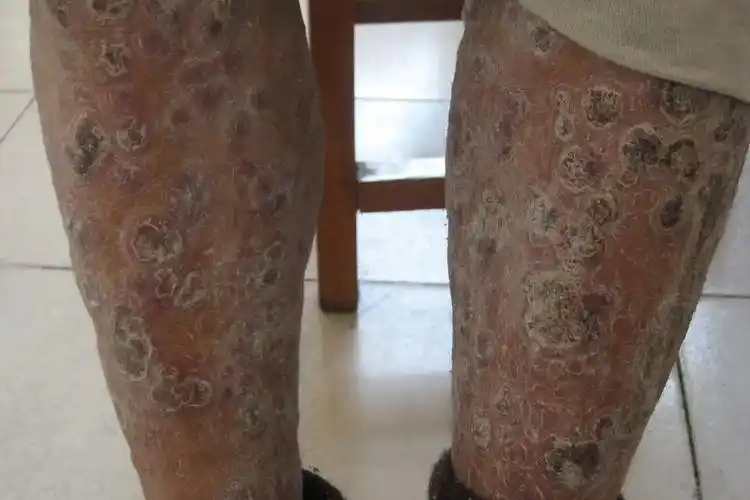 三期结节性梅毒疹图片